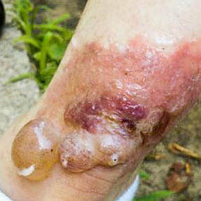 ankle-poison-ivy-rash