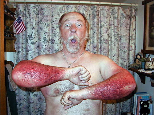 The Poison Ivy Skin Rash Hall of Fame 1 The King of the Poison Ivy Skin Rash Hall of Fame