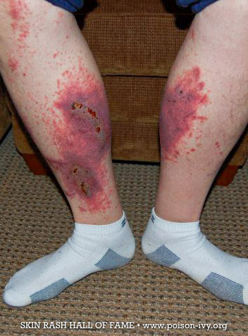 poison ivy calf rash