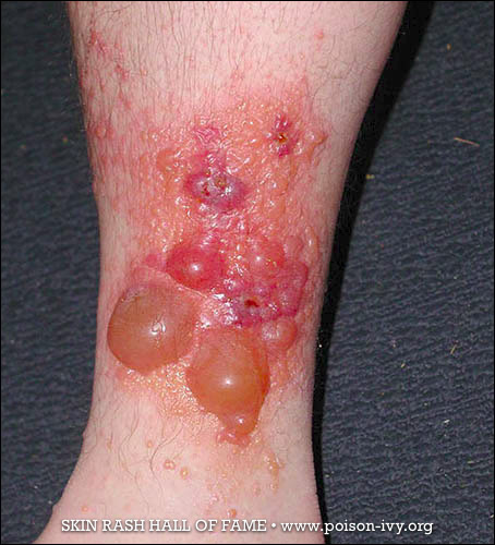 Multiple Ankle Skin Rash for Poison Ivy