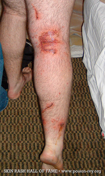 poison ivy back knee rash