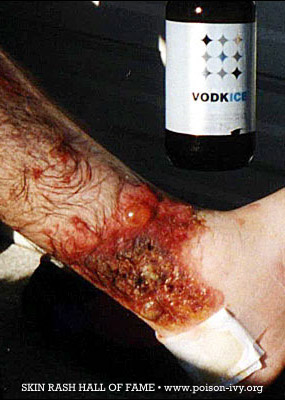 Poison Ivy Ankle Rash with Vodka