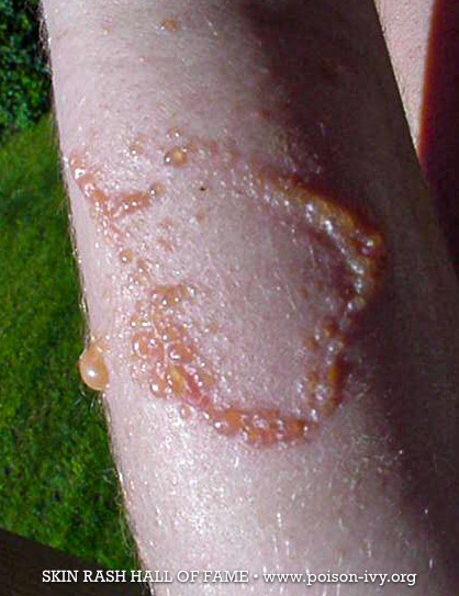 poison ivy ring rash