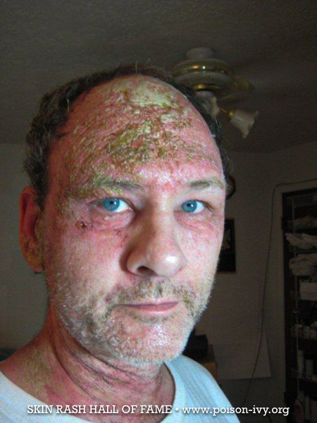 serious poison ivy face rash