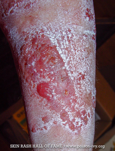 poison ivy crusty leg rash