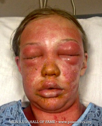 poison ivy body rash