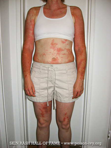 poison ivy body rash