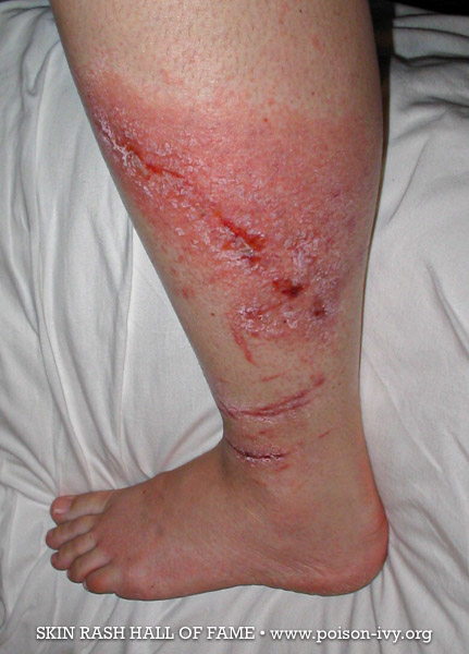 Calf poison ivy rash