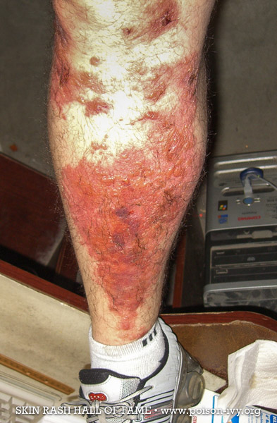 big calf and ankle poison ivy rash