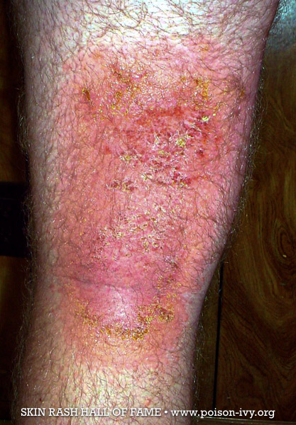 poison ivy leg rash