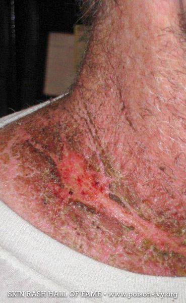 poison ivy neck rash