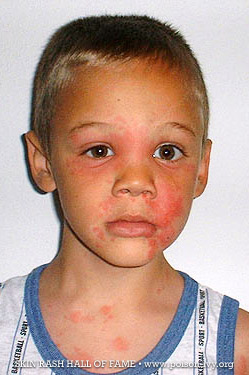 poison ivy rash boy