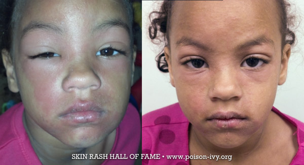 Little Girl with Poison Ivy Rash