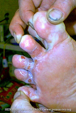 Nasty Toes Poison Ivy Rash