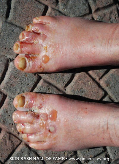 poison ivy toes rash