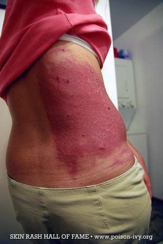 show me poison ivy rash