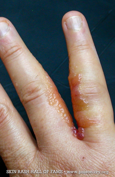 poison ivy rash between fingers