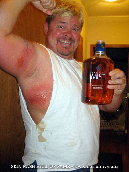 poison ivy rash with booze