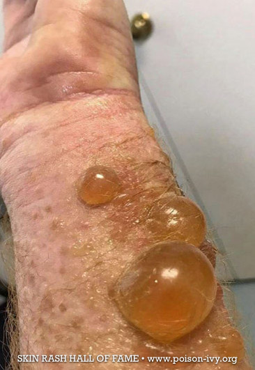 wrist bubble from poison ivy