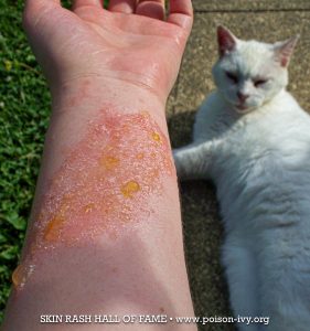 HOME 16 Forearm poison ivy