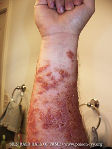 HOME 15 bad forearm poison ivy