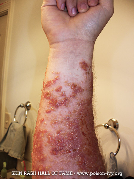 bad forearm poison ivy