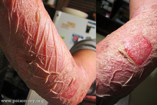 grandmother of all poison ivy rashes
