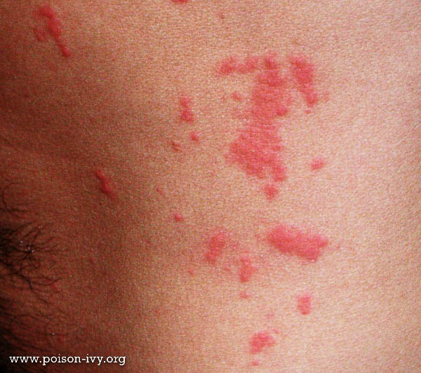 show me poison ivy rash