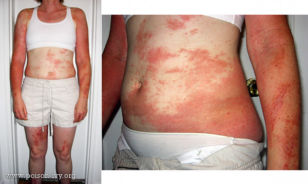 full-body-poison-ivy-rash