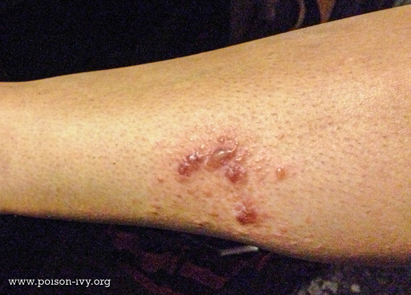 poison ivy leg rash