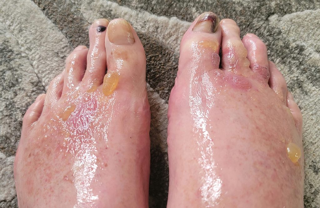 feet-poison-ivy-rash