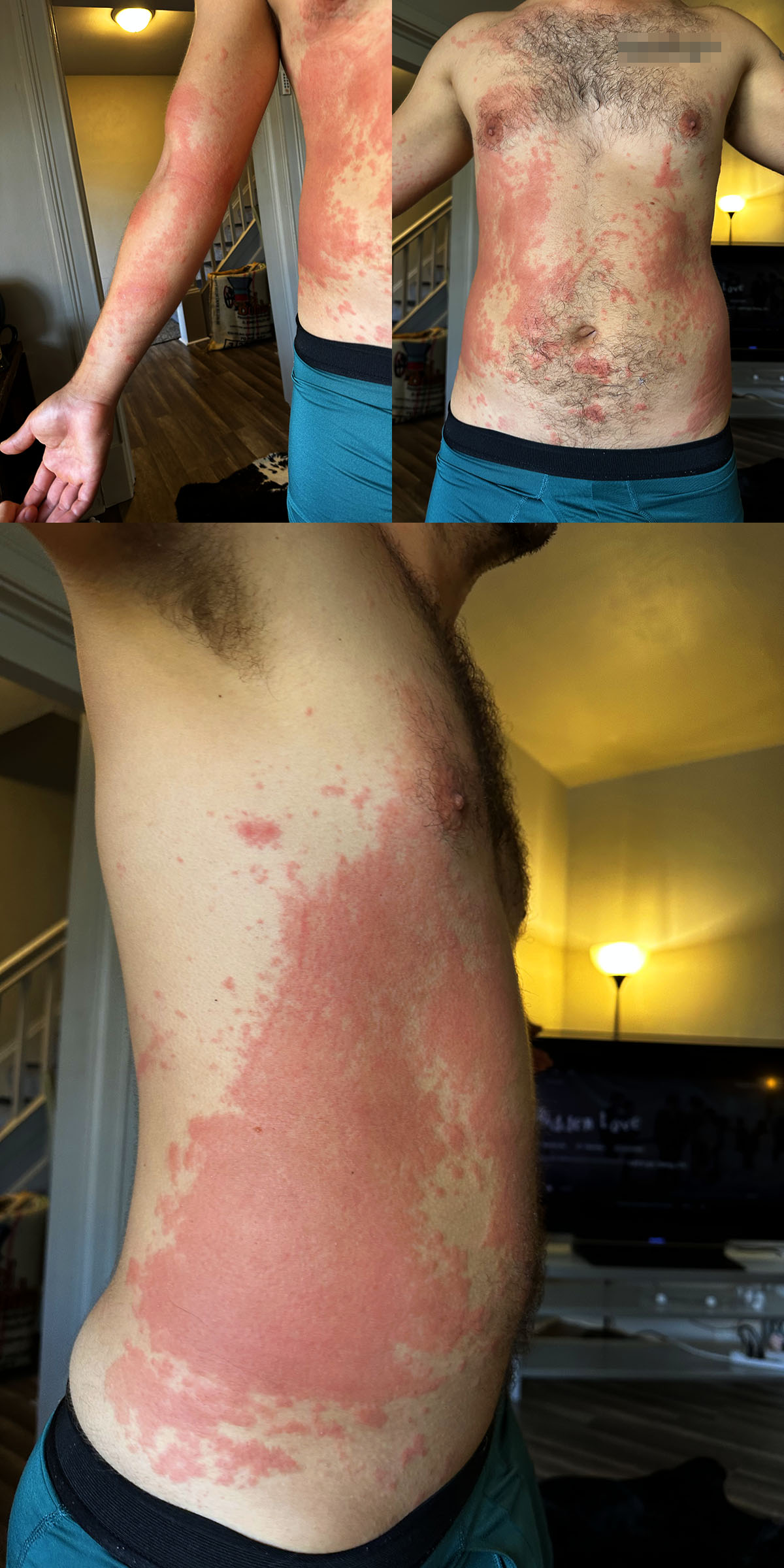 show me poison ivy rash