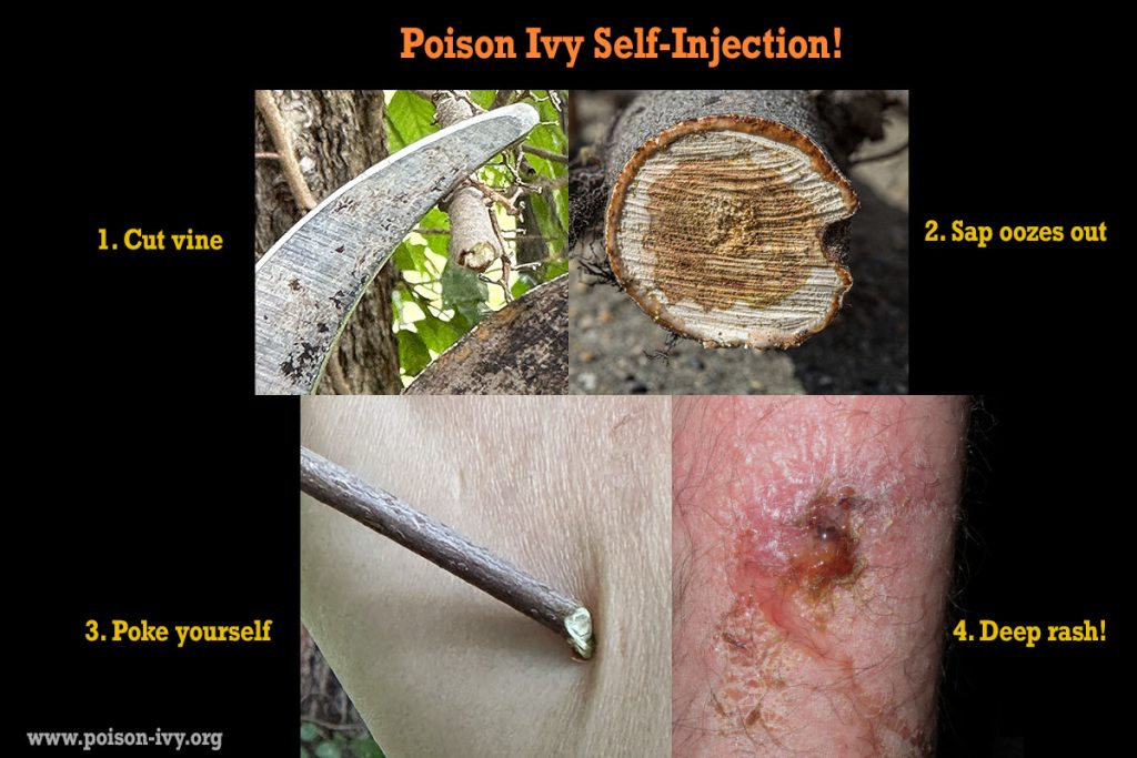 poison ivy self injection
