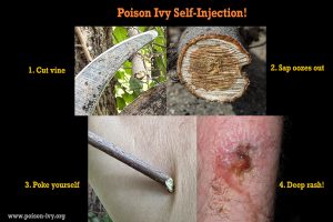 The Infamous Poison Ivy Skin Rash Hall of Fame 4 poison ivy self injection
