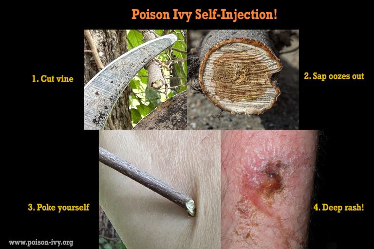 HOME 3 poison ivy self injection