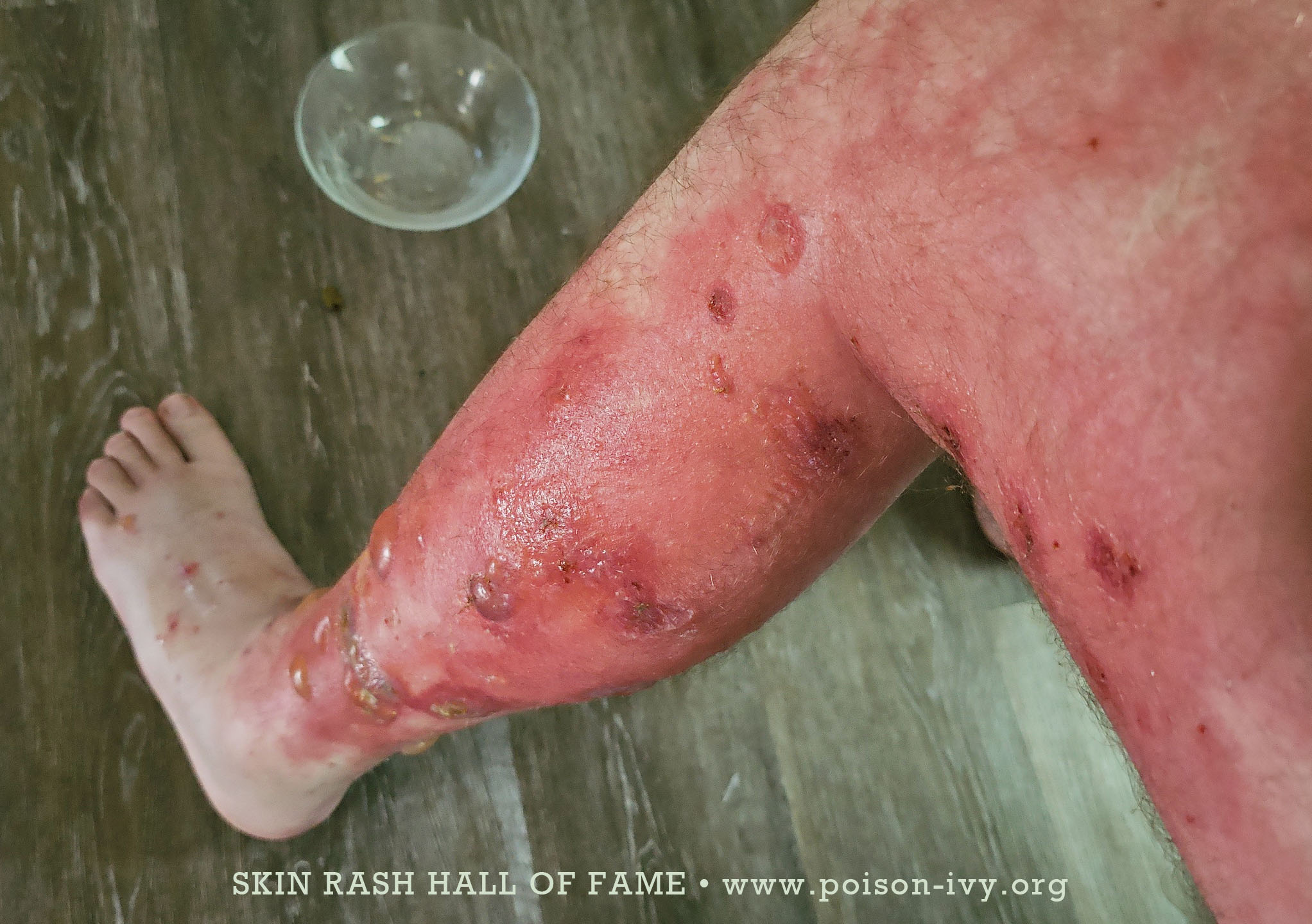 poison ivy skin rash leg