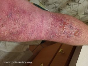 HOME 13 disc golf poison ivy rash